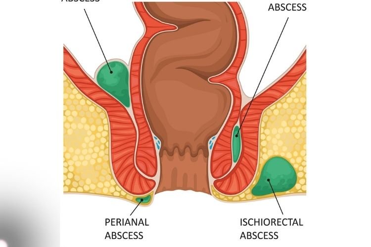 Advanced Laser Proctologist in Thane