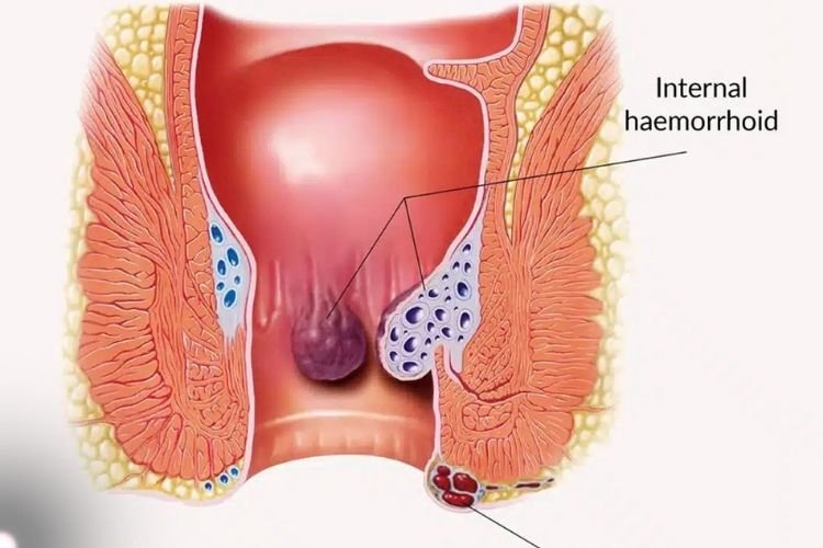 Advanced Laser Proctologist | Dr.Amol Gosavi | Thane