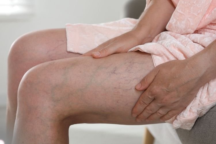 Varicose Veins Treatment | Dr Amol Gosavi