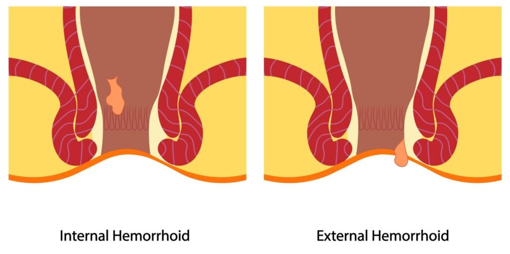 Laser Piles Treatment