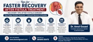 Recovery Tips After Fistula Surgery | Dr. Amol Gosavi