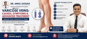 Varicose Veins Treatment in Thane | Dr. Amol Gosavi