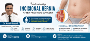 Incisional Hernia Treatment | Dr. Amol Gosavi